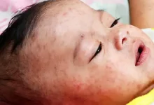 হঠাৎ হামের টিকা! ৫ বছরের কম বয়সী শিশুদের যা হচ্ছে জানলে চমকে যাবেন!