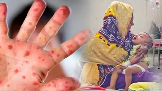 হঠাৎ হাম আক্রান্ত শিশুর তালিকা থেকে বাদ দিন এই খাবারগুলো, জানলে হতবাক হবেন!