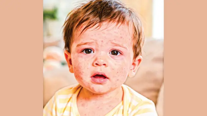 হঠাৎ ২১ শিশুর মৃত্যু! দেশে এ কোন রোগের উদ্বেগজনক প্রাদুর্ভাব?