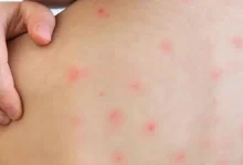 হামের টিকা দিতে ব্যর্থ ড. ইউনূসের সরকার? যা ঘটল শিশুদের সাথে!