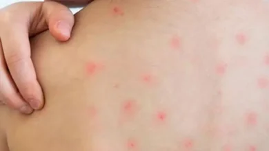 হামের টিকা দিতে ব্যর্থ ড. ইউনূসের সরকার? যা ঘটল শিশুদের সাথে!